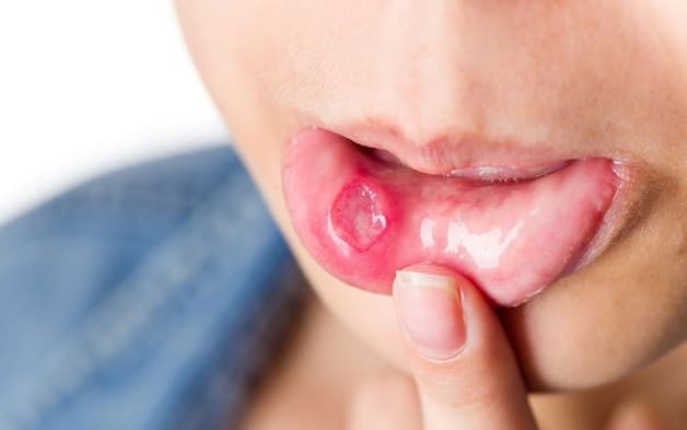 điều trị viêm lợi Herpes