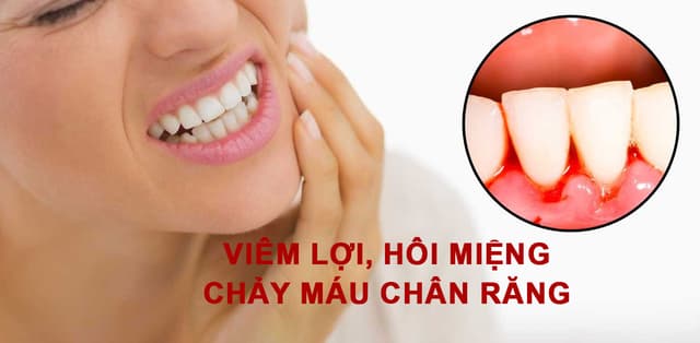 Bệnh lý viêm lợi hôi miệng chảy máu chân răng