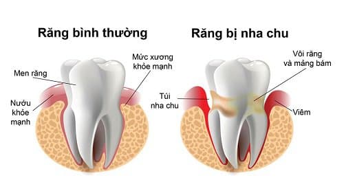 Răng bình thường so với răng bị viêm nha chu