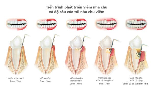 Sự khác nhau về triệu chứng viêm nướu và bệnh nha chu