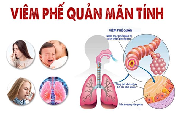 Giải đáp viêm phế quản mãn tính là gì-1