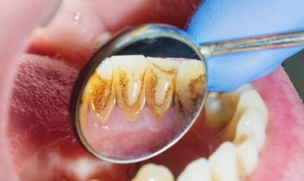 Làm thế nào để nhận biết cao răng lâu năm?