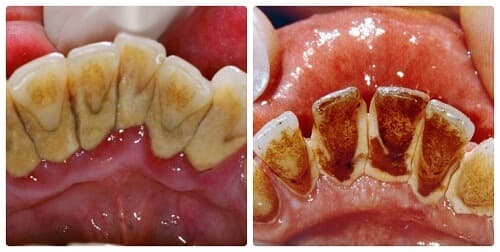 Tác động đáng lo ngại của vôi răng lâu năm