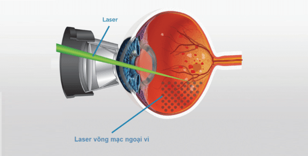 Laser quang đông là một trong những phương pháp phổ biến điều trị bệnh võng mạc trẻ sơ sinh