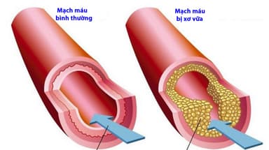 Xơ vữa động mạch: Triệu chứng, hậu quả