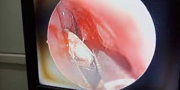 Hình ảnh thực tế dị vật trong mũi