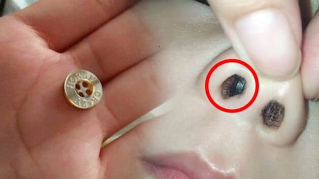 Xử lý dị vật mũi