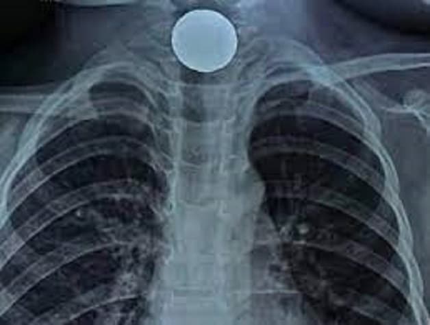 Cần xử trí hóc dị vật thực quản