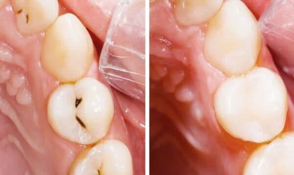 Hàn răng sâu sử dụng những vật liệu nào?