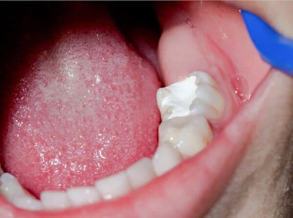 Hàn răng sâu khi quá muộn có thể gây hậu quả gì?