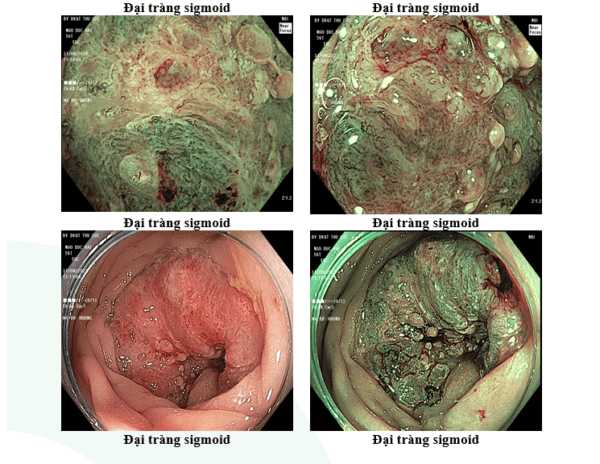 Kết quả nội soi đại tràng
