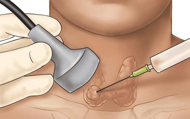 Sinh thiết tirads 5 tuyến giáp