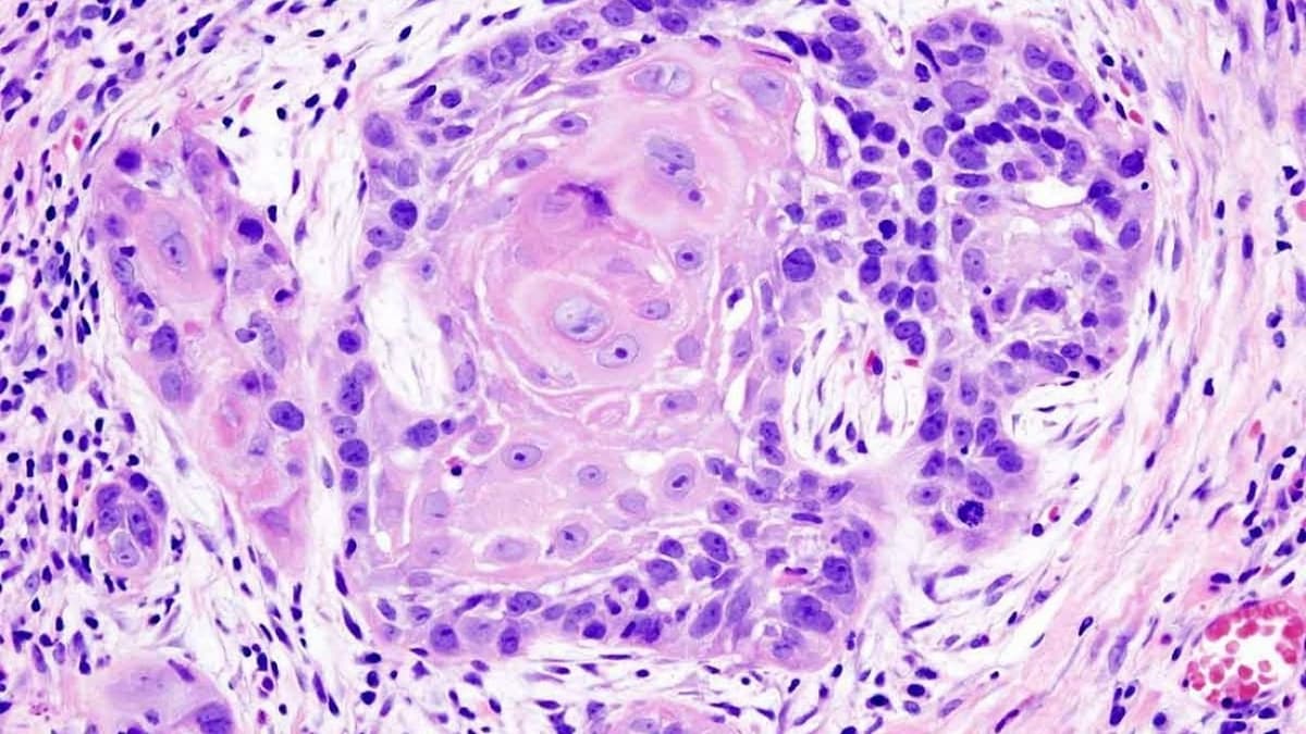 Tìm hiểu chung về bệnh ung thư phổi biểu mô tuyến