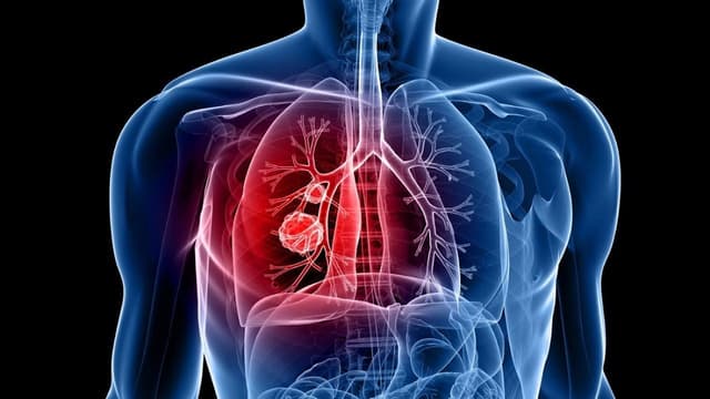 Tìm hiểu về tiên lượng sống của bệnh ung thư phổi