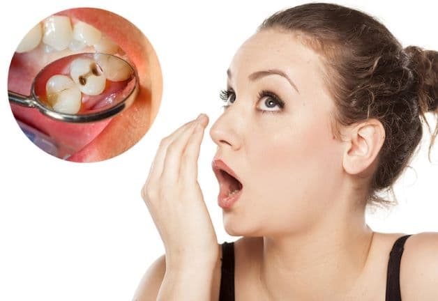 Bác sĩ chữa hôi miệng sâu răng