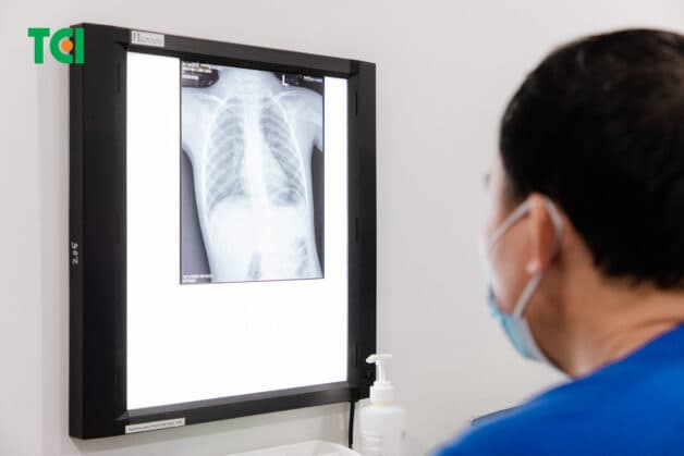 Một trong những biến chứng nghiêm trọng nhất của bệnh thủy đậu ở trẻ là viêm phổi.