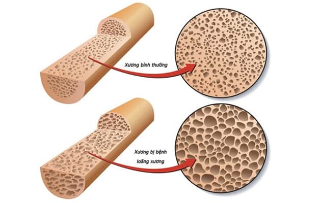 Bệnh tuyến giáp có nguy hiểm không - bệnh gây biến chứng về xương khớp.