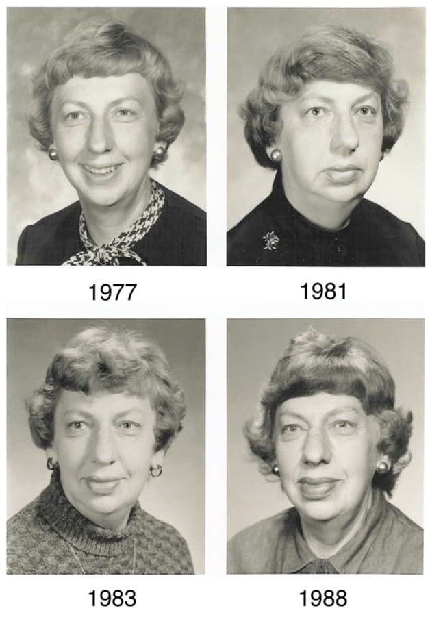 Sự thay đổi ngoại hình cua người bệnh bị to cực chi qua các năm.