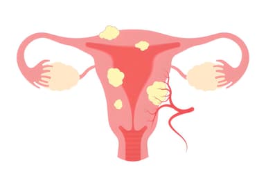 Hiểu rõ về bệnh u xơ tử cung: Triệu chứng, chẩn đoán và điều trị