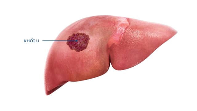 Những lưu ý quan trọng sau nút mạch gan cần biết