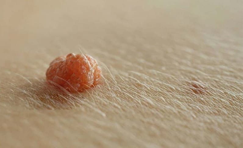 Sùi mào gà là một bệnh lây qua quan hệ tình dục