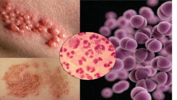 Có nhiều nguyên nhân gây ra các bệnh ở đường tình dục.