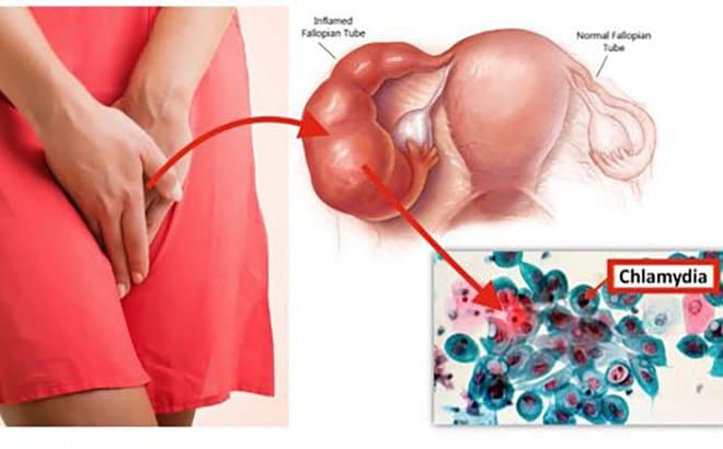 Bệnh Chlamydia không có dấu hiệu nhận biết rõ rệt, thường bị nhầm lẫn với bệnh phụ khoa
