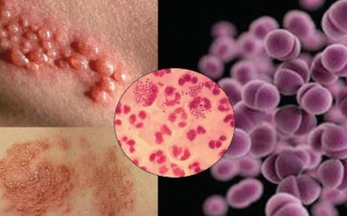 các bệnh lây qua quan hệ tình dục