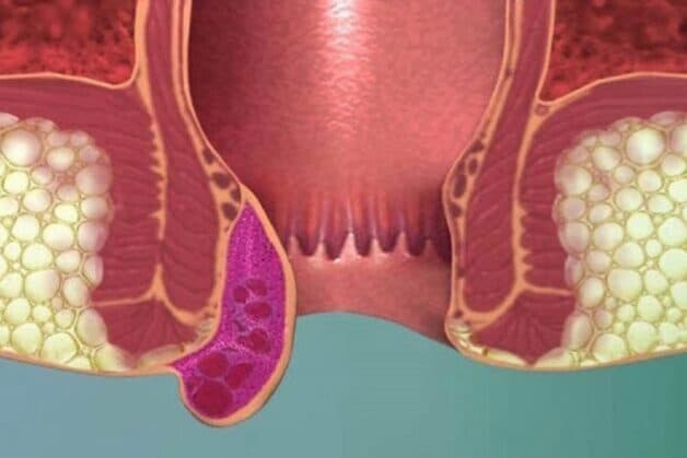 Hình ảnh búi trĩ ngoại mọc từ rìa hậu môn - cách chữa bệnh trĩ ngoại