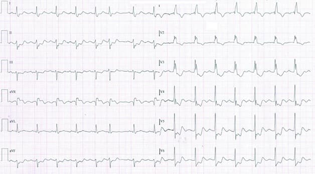 Kết quả đo điện tâm đồ