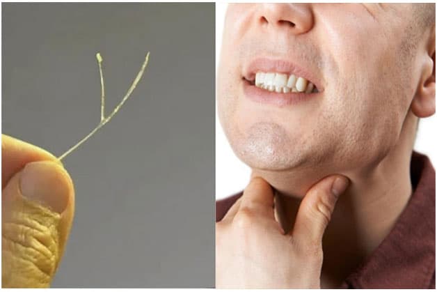 tìm cách lấy xương cá