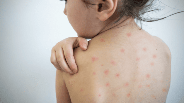 Tổn thương da do thủy đậu xuất hiện ở đầu, mặt, cổ trước và xuất hiện ở thân sau.