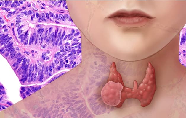 Carcinoma tuyến giáp thể nhú  là loại ung thư tuyến giáp thường gặp nhất và có tiên lượng tương đối tốt.
