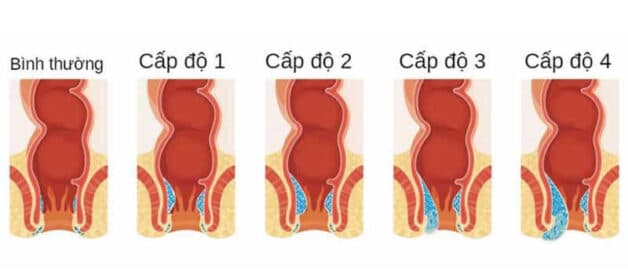 Laser Diode xử lý đặc biệt hiệu quả cho bệnh nhân trĩ giai đoạn 2,3