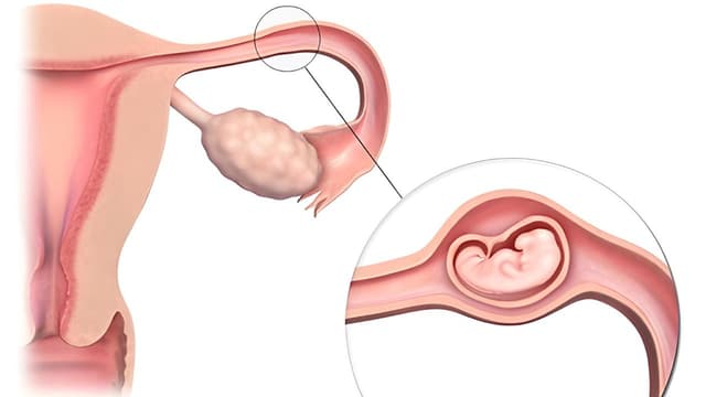 Những thông tin cần biết về chửa ngoài tử cung