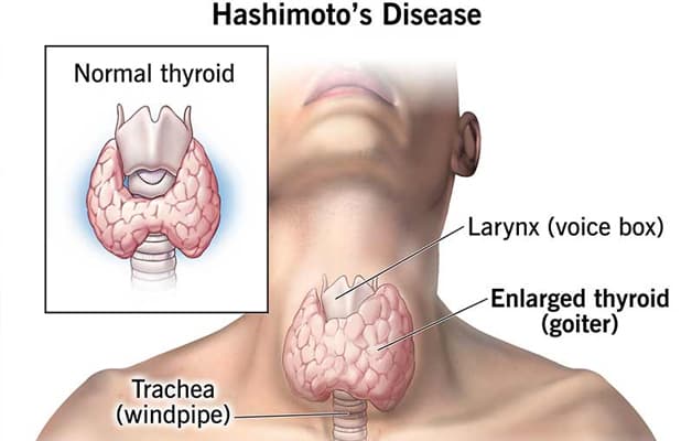 Dấu hiệu viêm tuyến giáp Hashimoto đặc trưng bởi bướu giáp lớn vùng cổ.