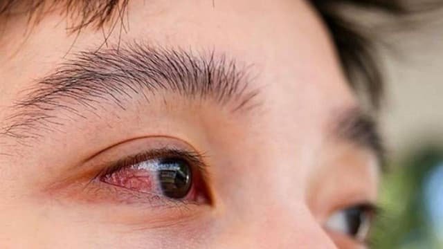 Đau mắt đỏ 1 bên: Nguyên nhân và giải pháp