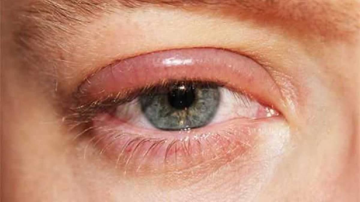 Những điều cần biết về đau mí mắt