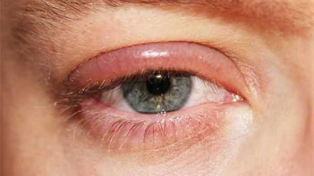 Những điều cần biết về đau mí mắt