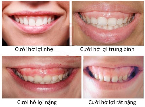 Tìm hiểu điều trị cười hở lợi giá bao nhiêu tất cả?