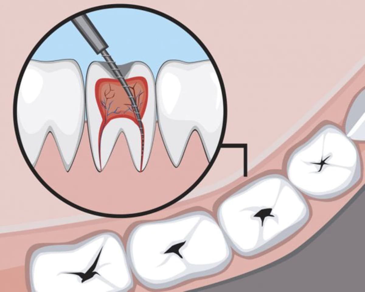 Điều trị tủy răng giá bao nhiêu và thông tin cần thiết