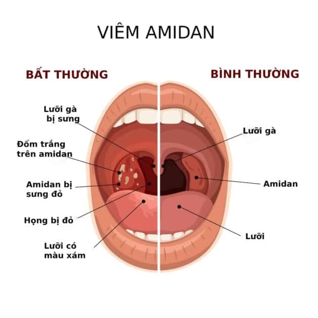 cách điều trị viêm amidan