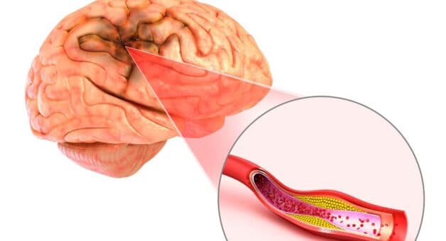 Phân loại đột quỵ não