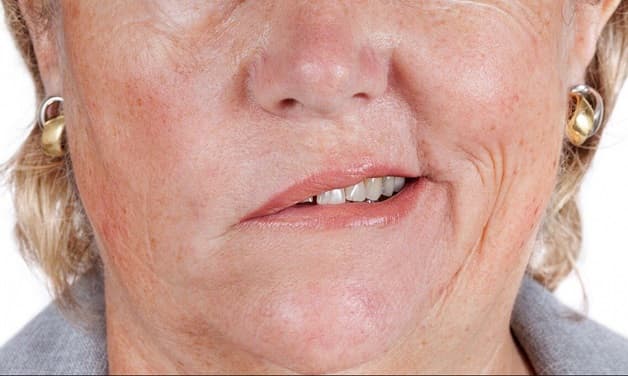 Triệu chứng đột quỵ