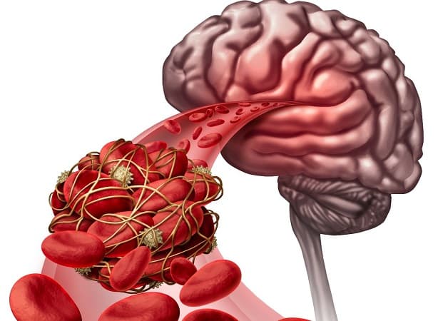 Đột quỵ não là bệnh như thế nào?