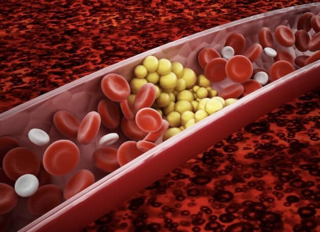 Gan nhiễm mỡ nguyên nhân là tình trạng mỡ máu cao