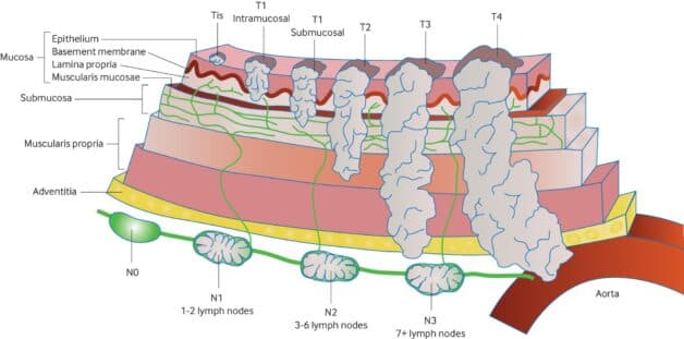 Ung thư thực quản ở giai đoạn đầu và phương pháp điều trị