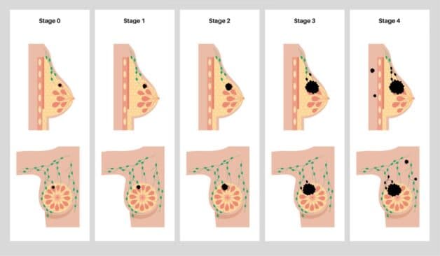 Các giai đoạn của bệnh ung thư vú