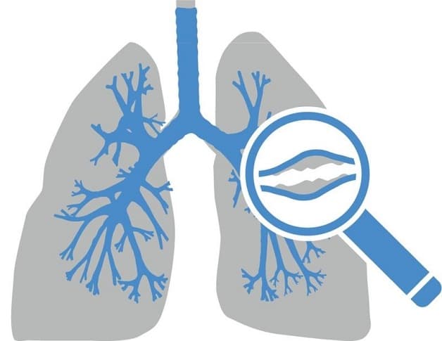 Giãn phế quản là gì?