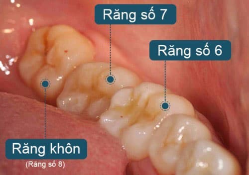 Thông tin cơ bản về răng khôn, khi nào có răng khôn